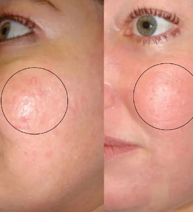 Dermabrasion Treatment