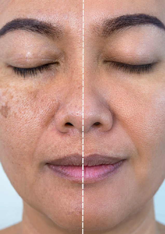 Melasma & Hyperpigmentation Treatment