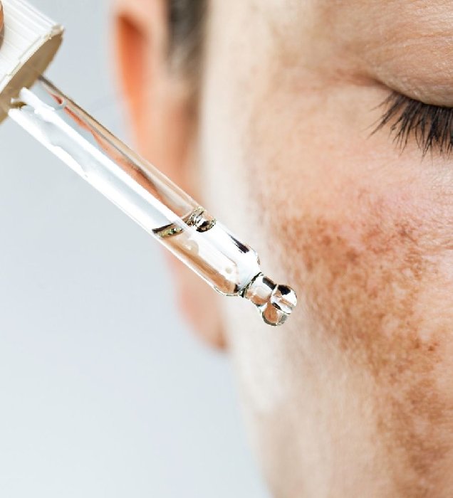 How Melasma Treatment Works