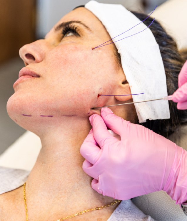 Thread Lift Treatment