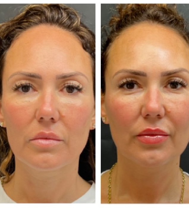 How Thread Lift Works