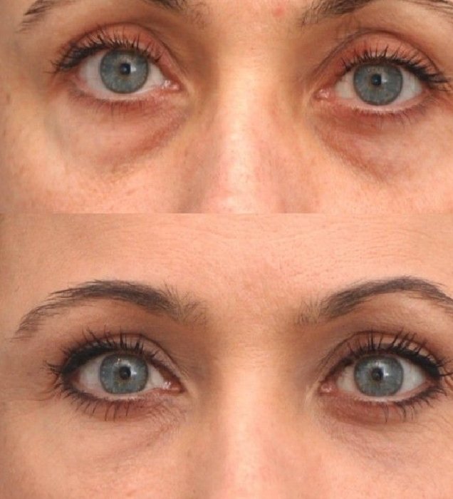 Undereye Treatment