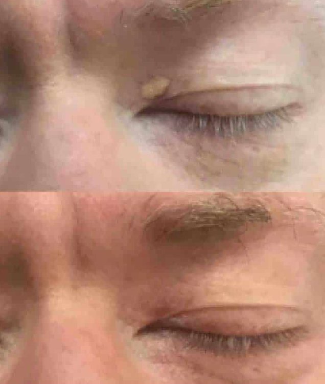 Xanthelasma Treatment