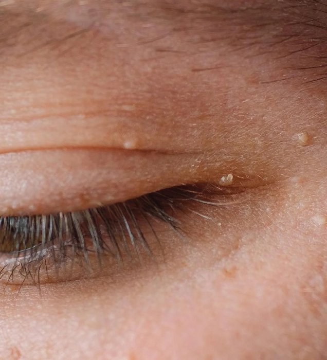 How Xanthelasma Removal Works