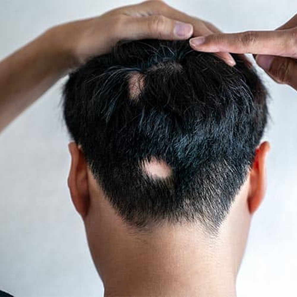Alopecia-Treatment