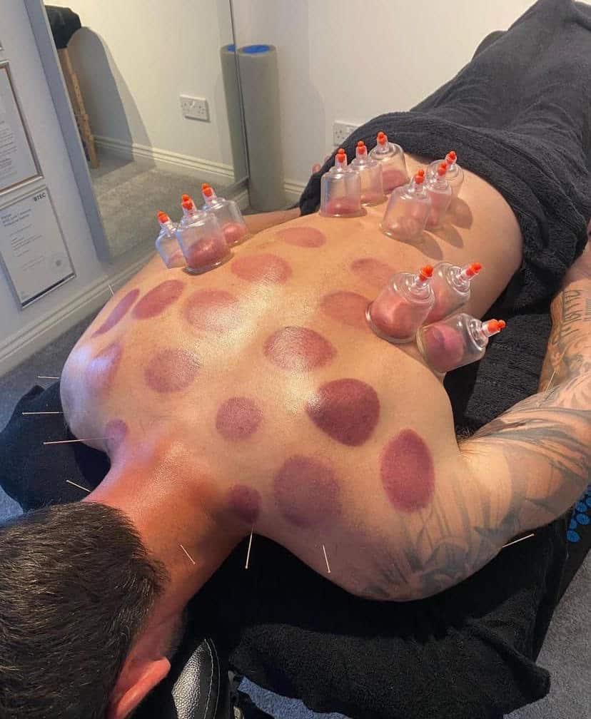 Cupping-Therapy