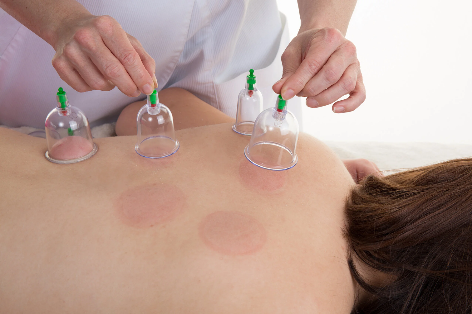 How Cupping-Therapy Procedure Works