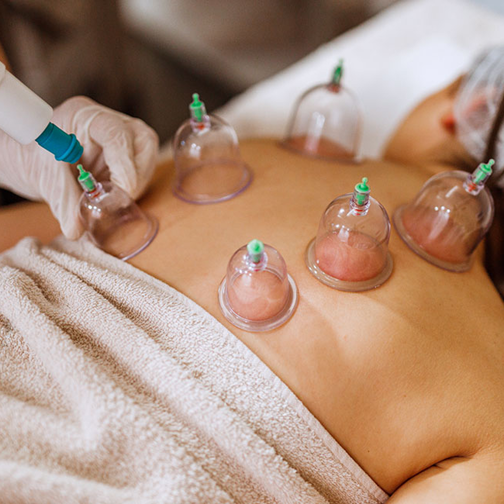 Cupping-Therapy