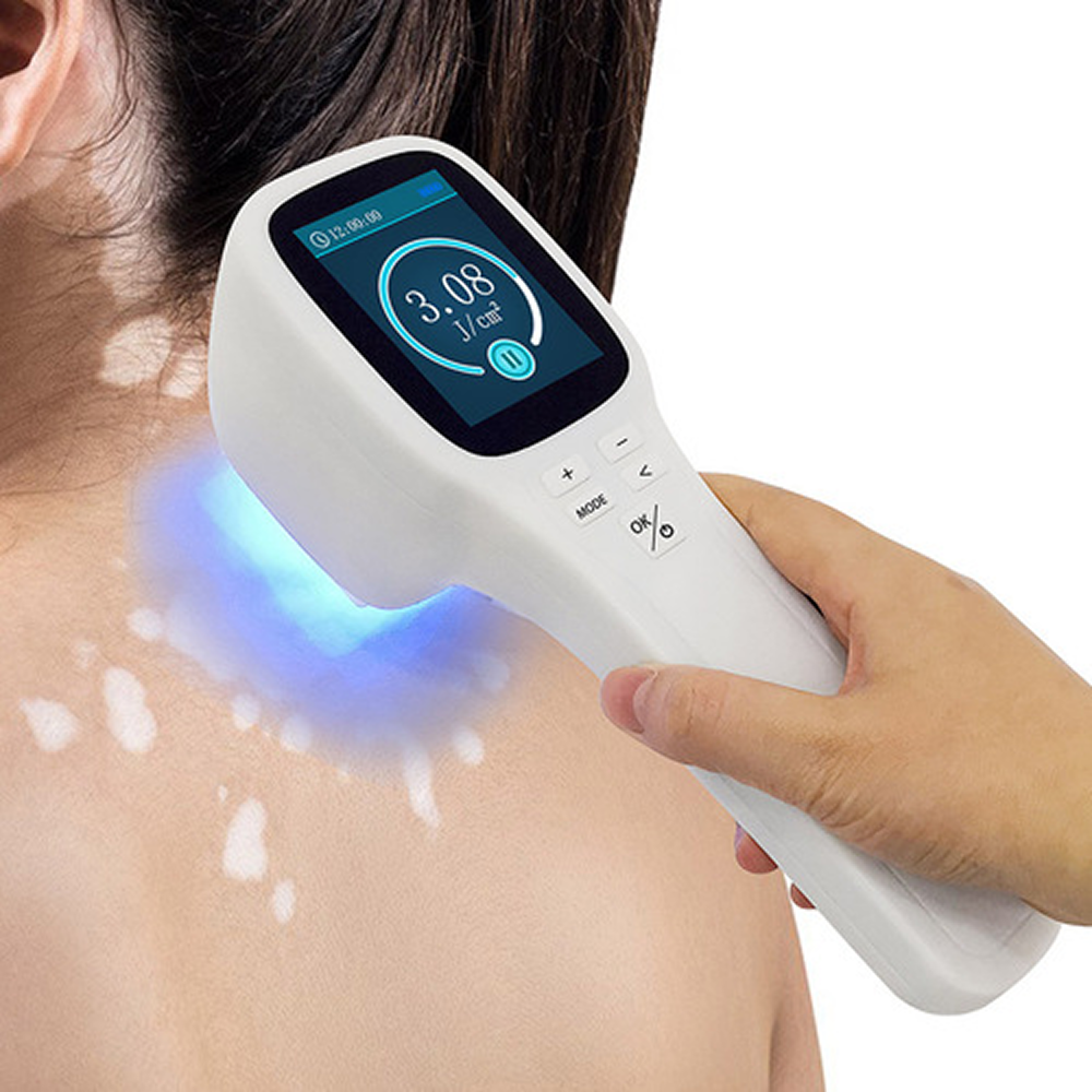 Eximer-Laser-for-Vitiligo
