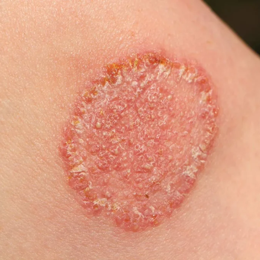 Fungal-Infection-Treatment