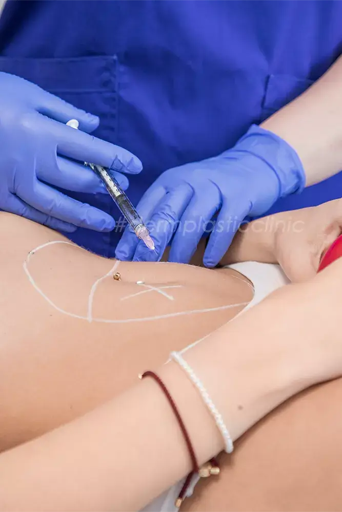 How Cupping-Therapy Procedure Works