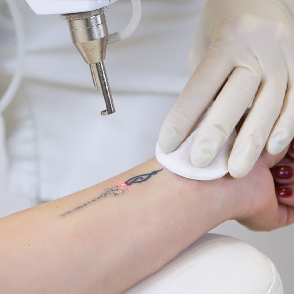 Laser-Tattoo-Removal