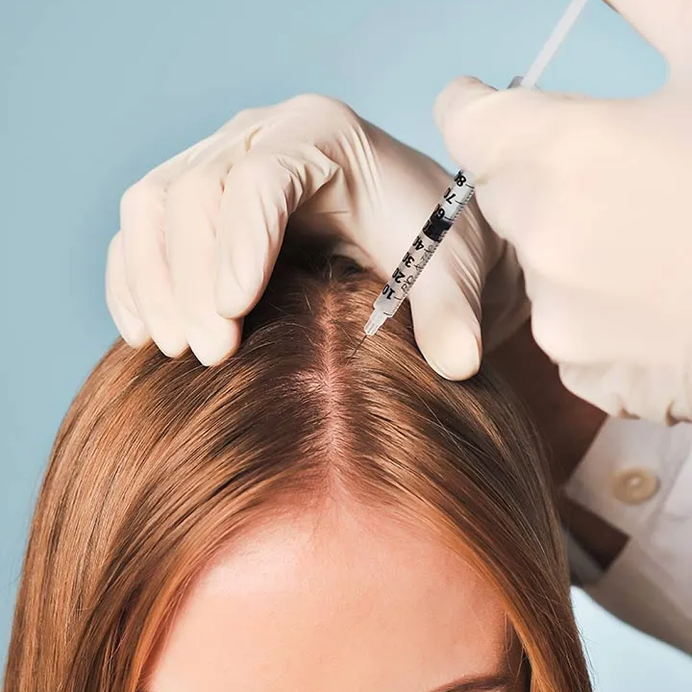 Mesotherapy-for-Hairfall-Control