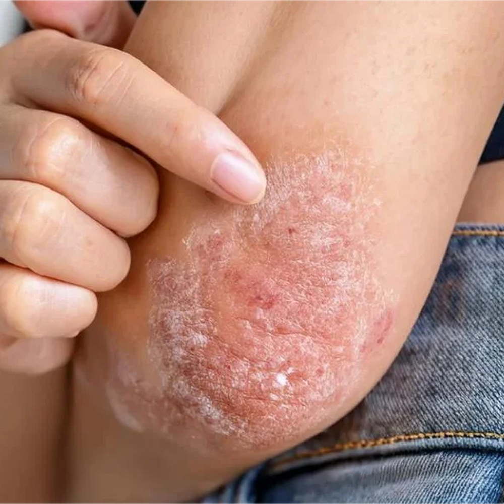 Psoriasis-Treatment