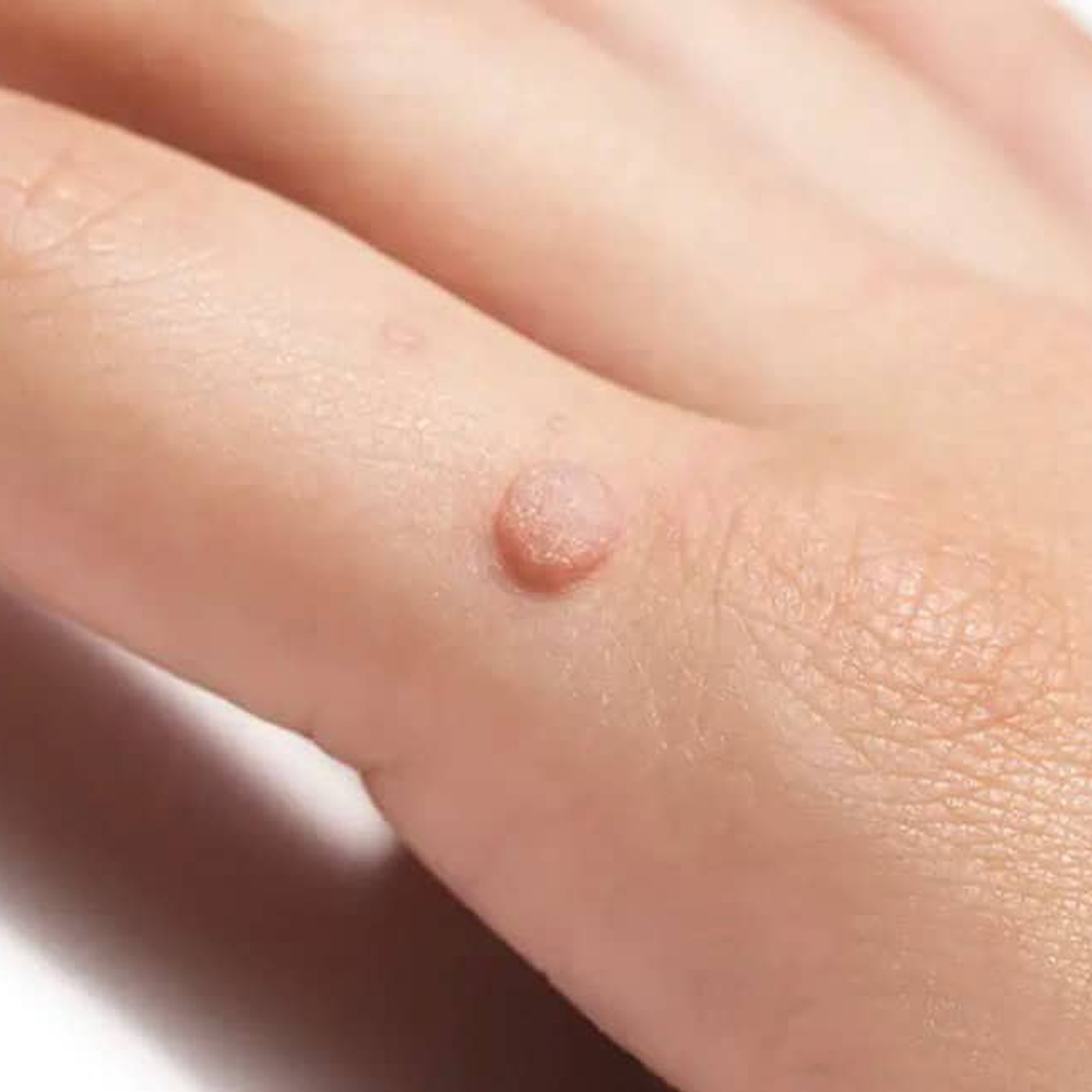 Wart-Removal
