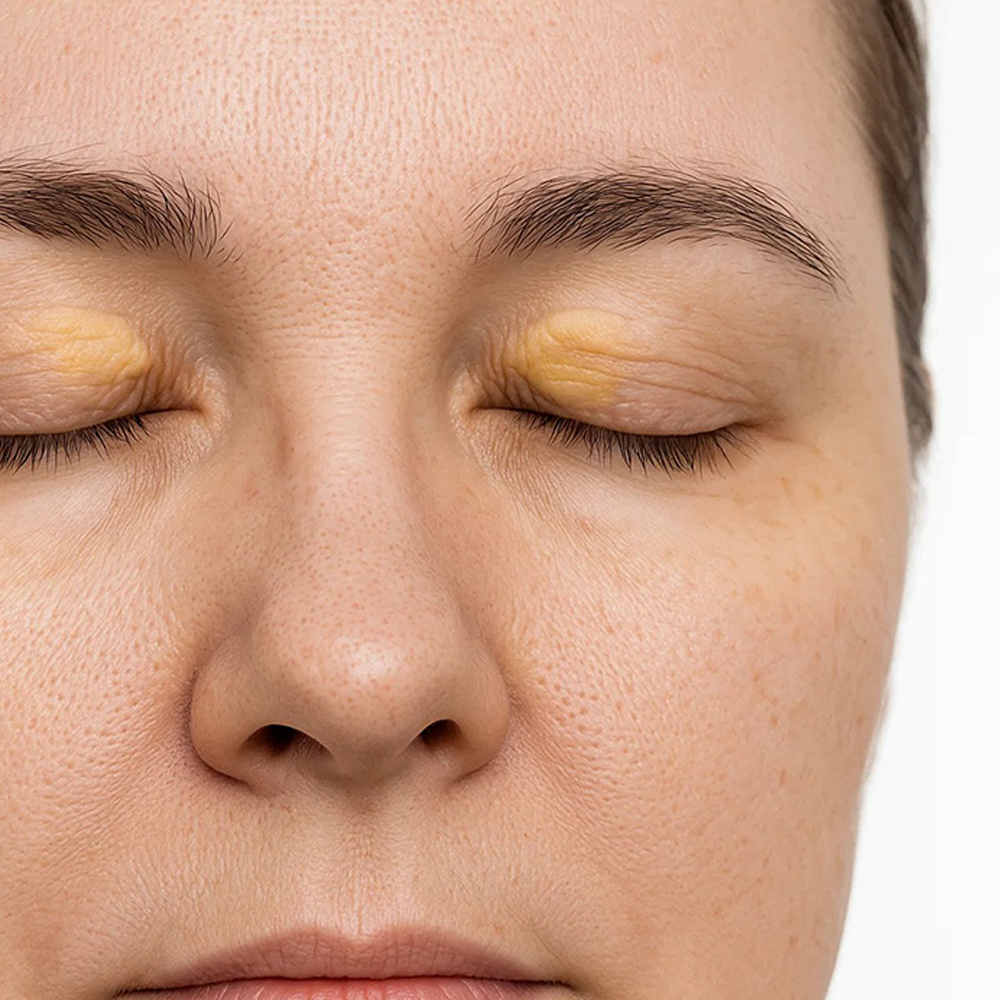 Xanthelasma-Treatment