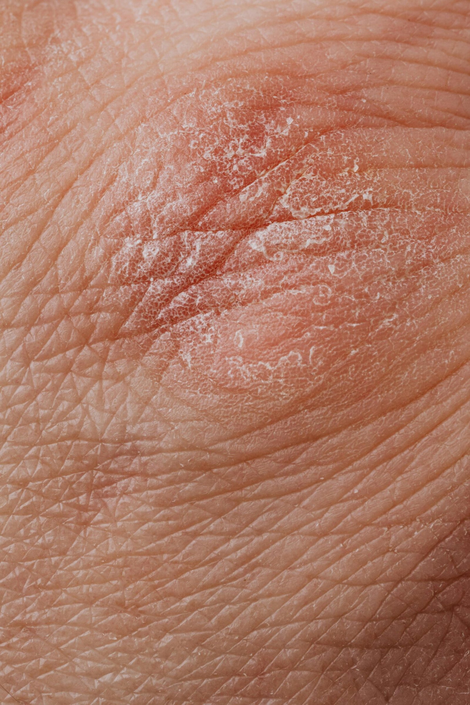eczema-treatment